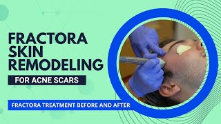 Fractora Skin Remodeling for Acne Scars  Fractora Treatment Before and After  Dr Jason Emer [upl. by Mahau]