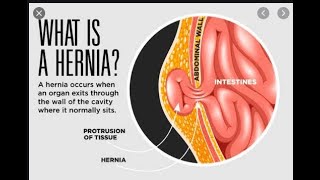 EVERYTHING YOU WANT TO KNOW ABOUT A HERNIA [upl. by Ellertnom208]