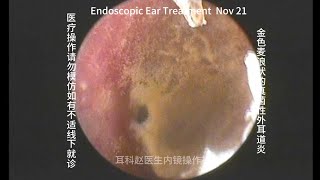 Ear wax removal Golden earwax fungus dry sheet cleaning 20241121 [upl. by Helfand]