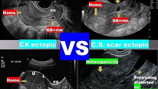 lecture 9 ultrasound of bleeding in early pregnancy 2 [upl. by Ahseinar]