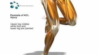 ACL Tear Sports Injury [upl. by Atin648]