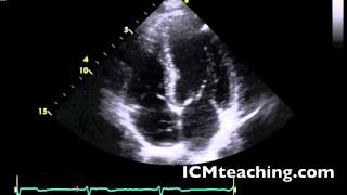 Apical 4 Chamber normal [upl. by Kiley]