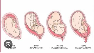 How to manage antepartum haemorrhage🚨😷drsaminakhurshidgynaecolog4661 [upl. by Lovmilla]