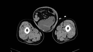 Case 7 73 year old male patient with abdominal pain [upl. by Dottie]