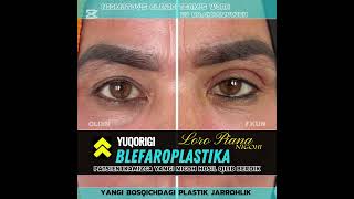 Yuqorigi blefaroplastika SANGAPURI 7kunВерхняя блефаропластика САНГАПУРИuzbekistan beautiful [upl. by Merridie]