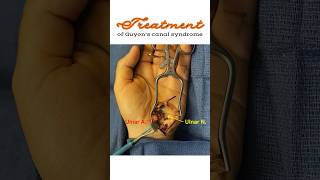 Treatment of Guyon’s canal syndrome Ulnar tunnel syndrome shorts [upl. by Peder941]