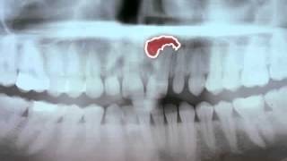 Zahnzyste  radikuläre Zyste [upl. by Melak]