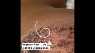 Ingrown hair on chin [upl. by Ingeborg]