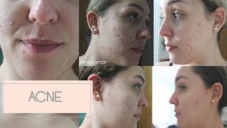 Tratamento de Acne Tetralysal Vitacid Epiduo e Triacneal  Steh Barbosa [upl. by Rennane]