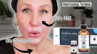 TCA Peel Tutorial 💕 Face  Neck  Chest  Shoulders [upl. by Shaine]