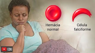 Anemia falciforme o que é sintomas causas e tratamento [upl. by Ebby]