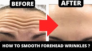 HOW TO GET RID OF FOREHEAD WRINKLES  GET RID OF FOREHEAD LINES  REMOVE WRINKLES [upl. by Pettifer]