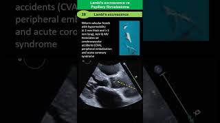 Lambls Excrescences vs Papillary Fibroelastoma [upl. by Tristis]