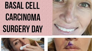 Basal Cell Carcinoma Surgery Day [upl. by Bobinette205]