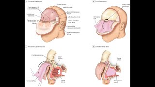 Total Septal Perforation Repair With a Pericranial Flap [upl. by Anec]