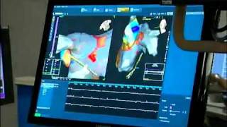 3D Electrical Mapping of the Heart [upl. by Claudianus]