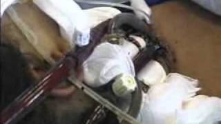 Extracorporeal Membrane Oxygenation ECMO [upl. by Dlared]