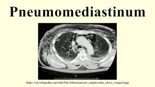 Pneumomediastinum [upl. by Elorak]