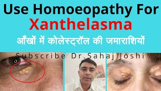 Xanthelasma Homeopathic medicine for Xanthelasma [upl. by Stanzel630]