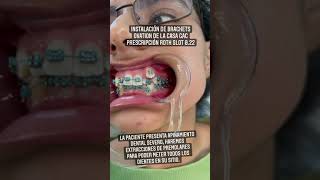 ASI SE PONEN UNOS BRACKETS CORRECTAMENTE ❤️ CASO DE EXTRACCIONES DE PREMOLARES shorts [upl. by Spatola17]