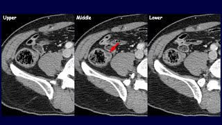 Is this an appendiceal lesion  Colitis cystica profunda amp Gastritis cystica profunda [upl. by Homer650]