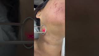 co2 fractional laser treatment [upl. by Frangos]