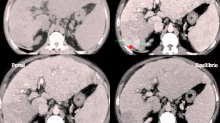 AULA Lesões hepáticas focais  Focal liver lesions [upl. by Ahsyle]