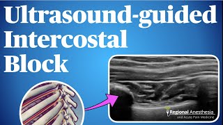 UltrasoundGuided Intercostal Nerve Block [upl. by Schlessel]