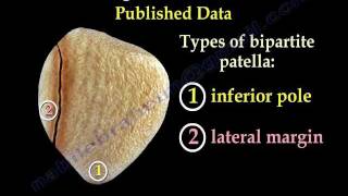 Bipartite Patella  Everything You Need To Know  Dr Nabil Ebraheim [upl. by Aciemaj]