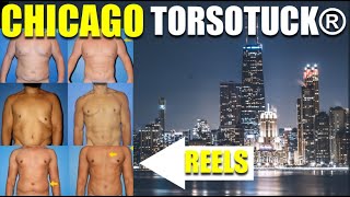 TorsoTuck® with BodyBanking®  Male Plastic Surgery Chicago [upl. by Coulombe]