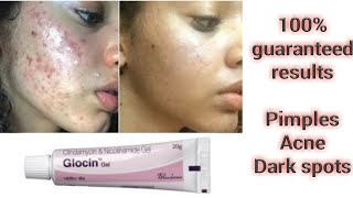 Glocin gel  clindamycin phosphate and nicotinamide gel  For pimples acne dark spots n wrinkles [upl. by Fotina564]