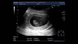 Missed Abortion with Pregnancy of about 10 weeks [upl. by Uriah896]