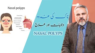 Nasal Polyps treatment in urdu I ناک کی غدود وجوہات اورعلاج I Nasal Polyps Symptoms I Naak ke Gadood [upl. by Ellehcrad]