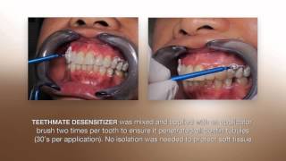 Desensitizing Procedure using the NEW TEETHMATE DESENSITIZER from Kuraray [upl. by Lulita]