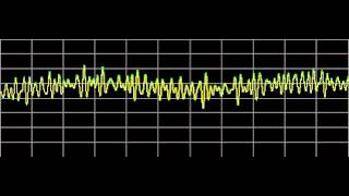 Hemangioma  Rife Frequencies [upl. by Arnon]