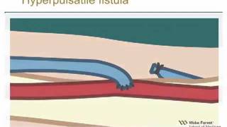 Physical Examination of Arteriovenous Fistula [upl. by Eyoj]