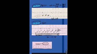 كيفية حساب معدل ضربات القلب Heart Rate من ورقة رسم القلب انشروهاللاستفادة [upl. by Lesab]