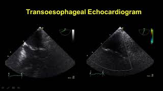 CARDIOGENIC PULMONARY OEDEMA AND ITS MANAGEMENT [upl. by Pauletta333]