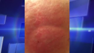 Skin Rash Leads to Shocking Diagnosis [upl. by Ailbert]