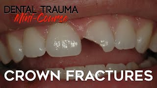 Dental Trauma MiniCourse  Part 4  Dental Trauma Guide  Crown Fractures [upl. by Treblig794]