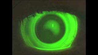 AirFlex irregular keratoconus cornea hybrid contact lens [upl. by Ahseila]