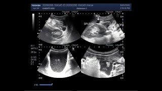 Ultrasound Video of Hemoperitoneum also called hematoperitoneum Hematuria amp intestinal obstruction [upl. by Corina866]