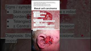 Basal cell carcinoma [upl. by Irim]