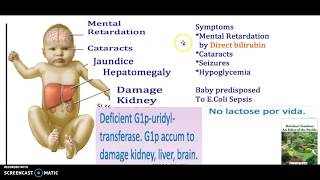 What causes galactosemia  Symptoms Types Genetic Testing Treatment Diet Safe food USMLE NCLEX 3 Mn [upl. by Rosario]