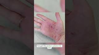 Hand eczema requires deep moisturization Try this Zudaifu 3rd generation eczema zudaifu [upl. by Elatsyrc]