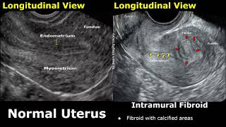 Uterus Ultrasound Normal Vs Intramural Fibroid Images  Uterine Leiomyomas USG Cases [upl. by Graehl]