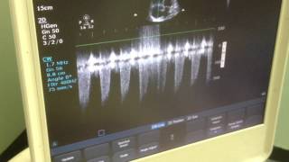 McConnells sign due to massive pulmonary embolism [upl. by Fen]