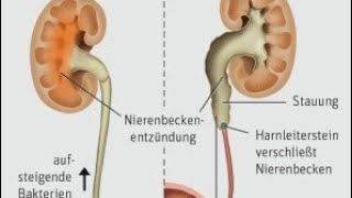 Nierenbeckenentzündung oder Pyelonephritis [upl. by Akenot590]