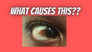 Causes of brown spot on eye  Patch  Discolouration Pigment  Pterygium Conjunctival Nevus [upl. by Ahseirej462]