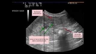 Endometritis not pyometra dog [upl. by Lamoree]